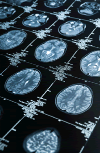 Alzheimer Brain